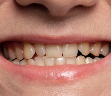 Before Smile Treatment