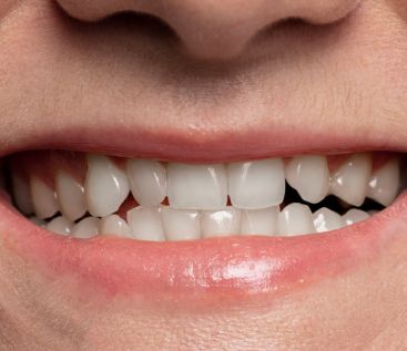 After Smile Treatment